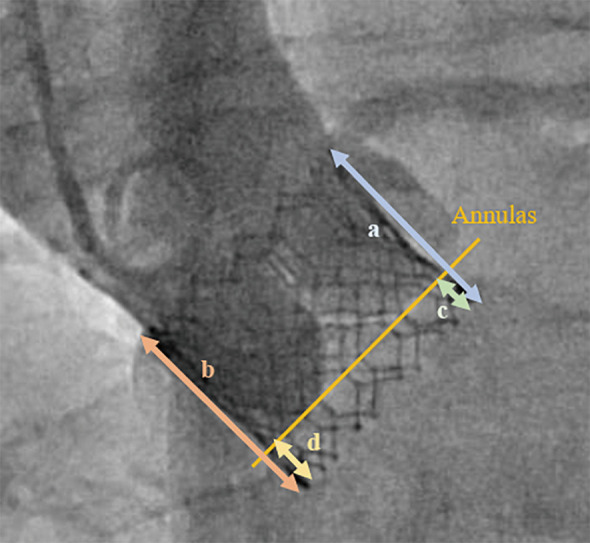 Risk of Coronary Occlusion Due to Sinus Sequestration by Redo Transcatheter Aortic Valve Implantation in Japanese Patients With SAPIEN 3.