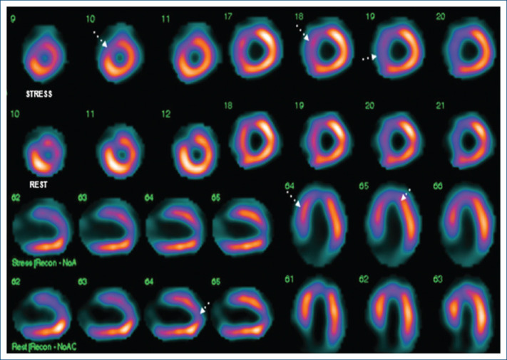 An unusual association: Chronic coronary syndrome and Bland-White-Garland syndrome.