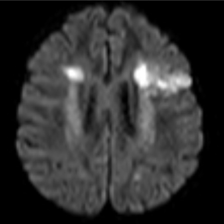 A case report overlapped vaccine and COVID-19 in disseminated atherosclerosis.