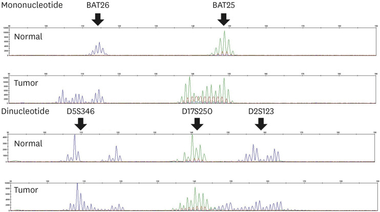 Comprehensive Study of Microsatellite Instability Testing and Its Comparison With Immunohistochemistry in Gastric Cancers.