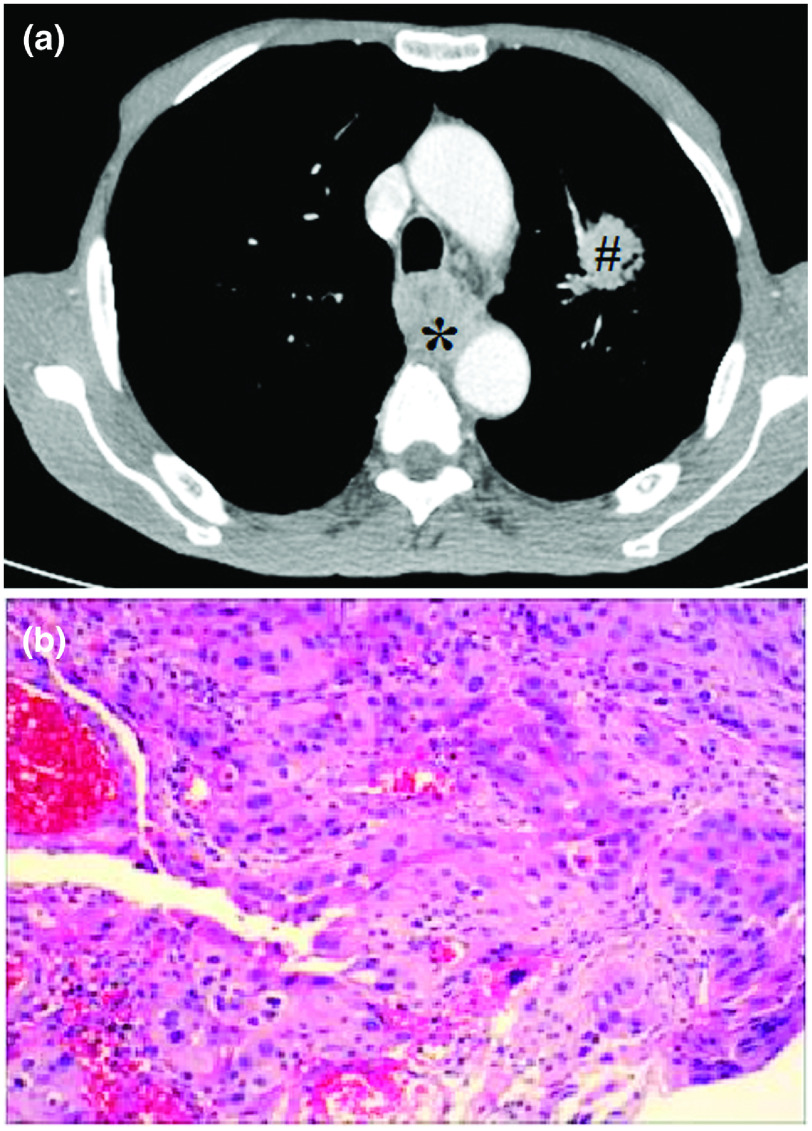 Fluoroscopic Removal of Embedded Esophageal Self-Expanding Metal Stents: Stent-in-Stent Combined with Guidewire Lasso Technique.