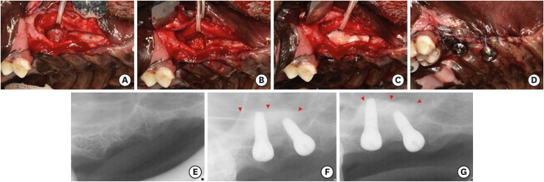 The impact of polydeoxyribonucleotide on early bone formation in lateral-window sinus floor elevation with simultaneous implant placement.