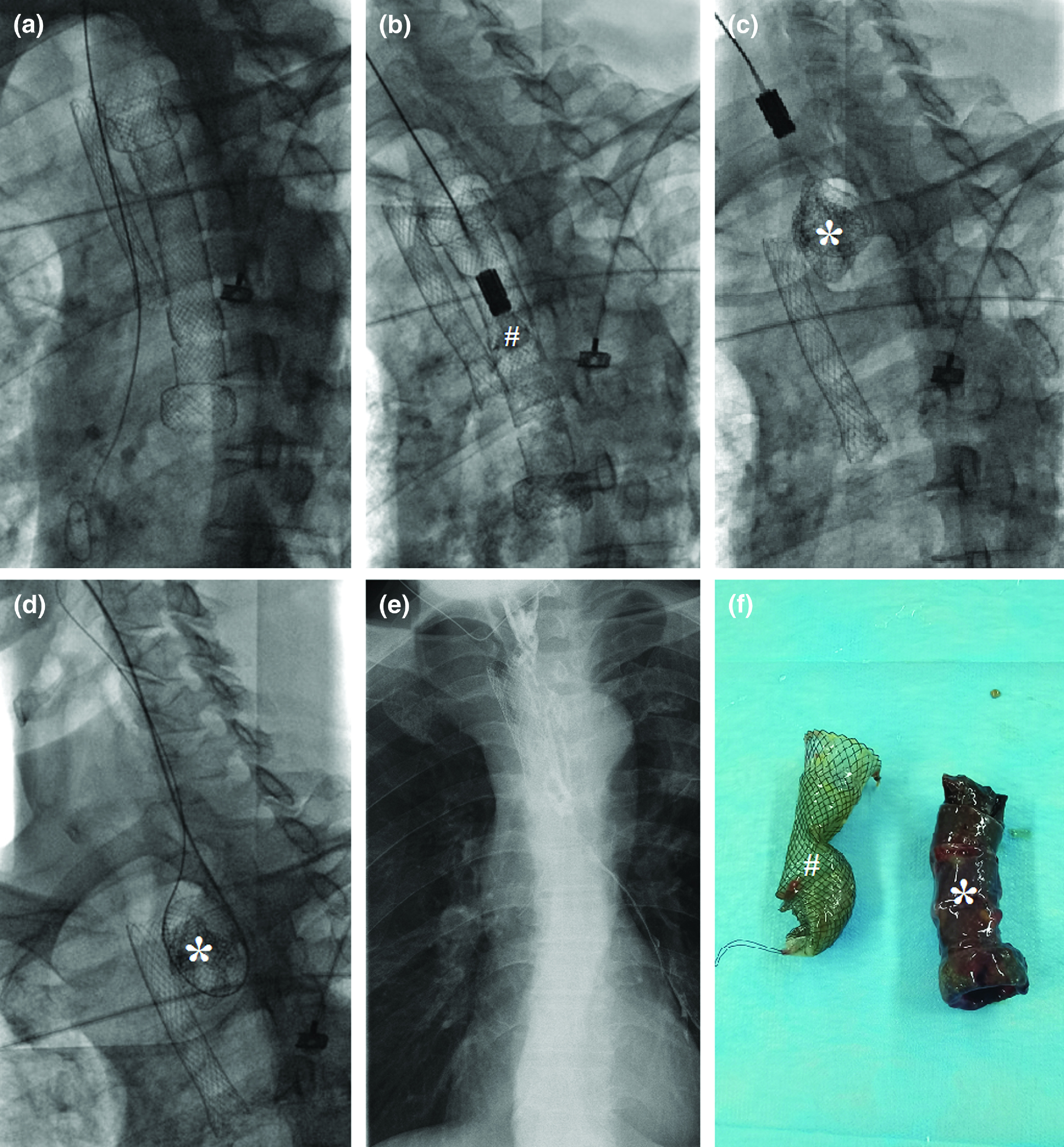 Fluoroscopic Removal of Embedded Esophageal Self-Expanding Metal Stents: Stent-in-Stent Combined with Guidewire Lasso Technique.