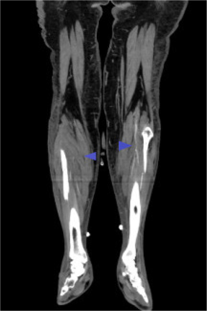 A case report overlapped vaccine and COVID-19 in disseminated atherosclerosis.