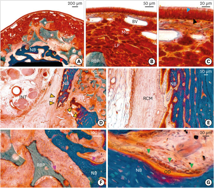 The impact of polydeoxyribonucleotide on early bone formation in lateral-window sinus floor elevation with simultaneous implant placement.