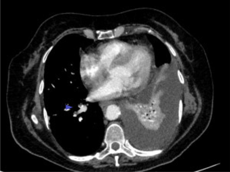 A case report overlapped vaccine and COVID-19 in disseminated atherosclerosis.