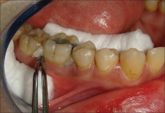 Clinical and Radiographic Evaluation of Locally Delivered Plant Stem Cells for Treatment of Periodontitis: Randomized Clinical Trial.