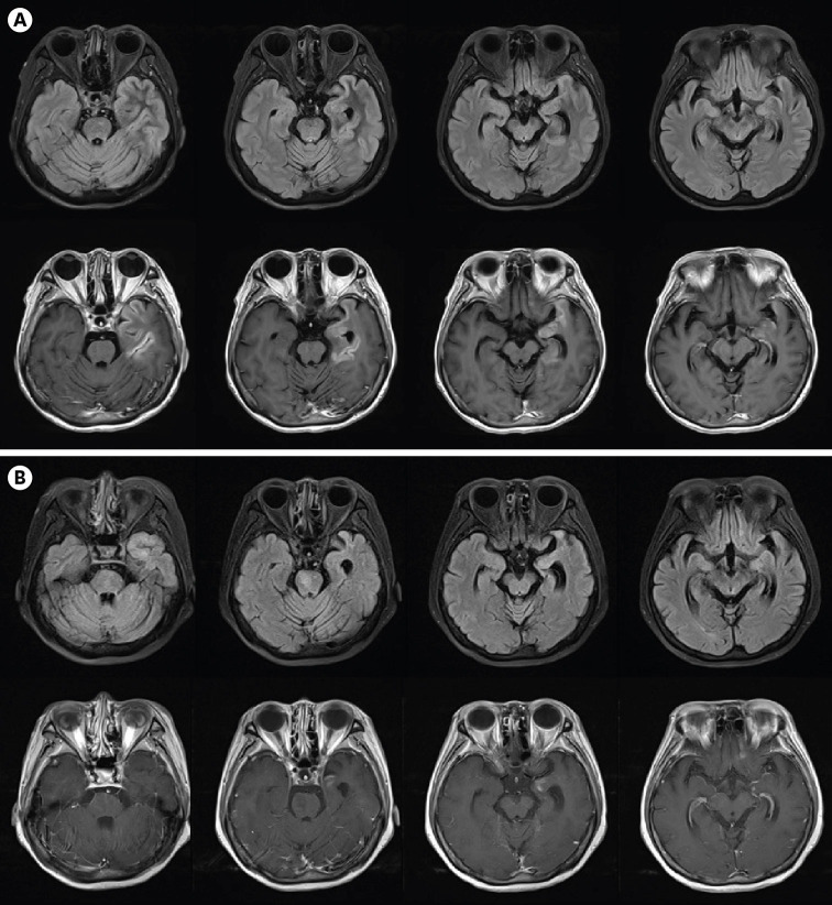 Post COVID-19 Vaccination Encephalitis as a Cause of Subacute Progressive Dementia: A Case Report and Literature Review.