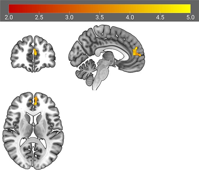 Adolescents' neural reactivity to parental criticism is associated with diminished happiness during daily interpersonal situations.