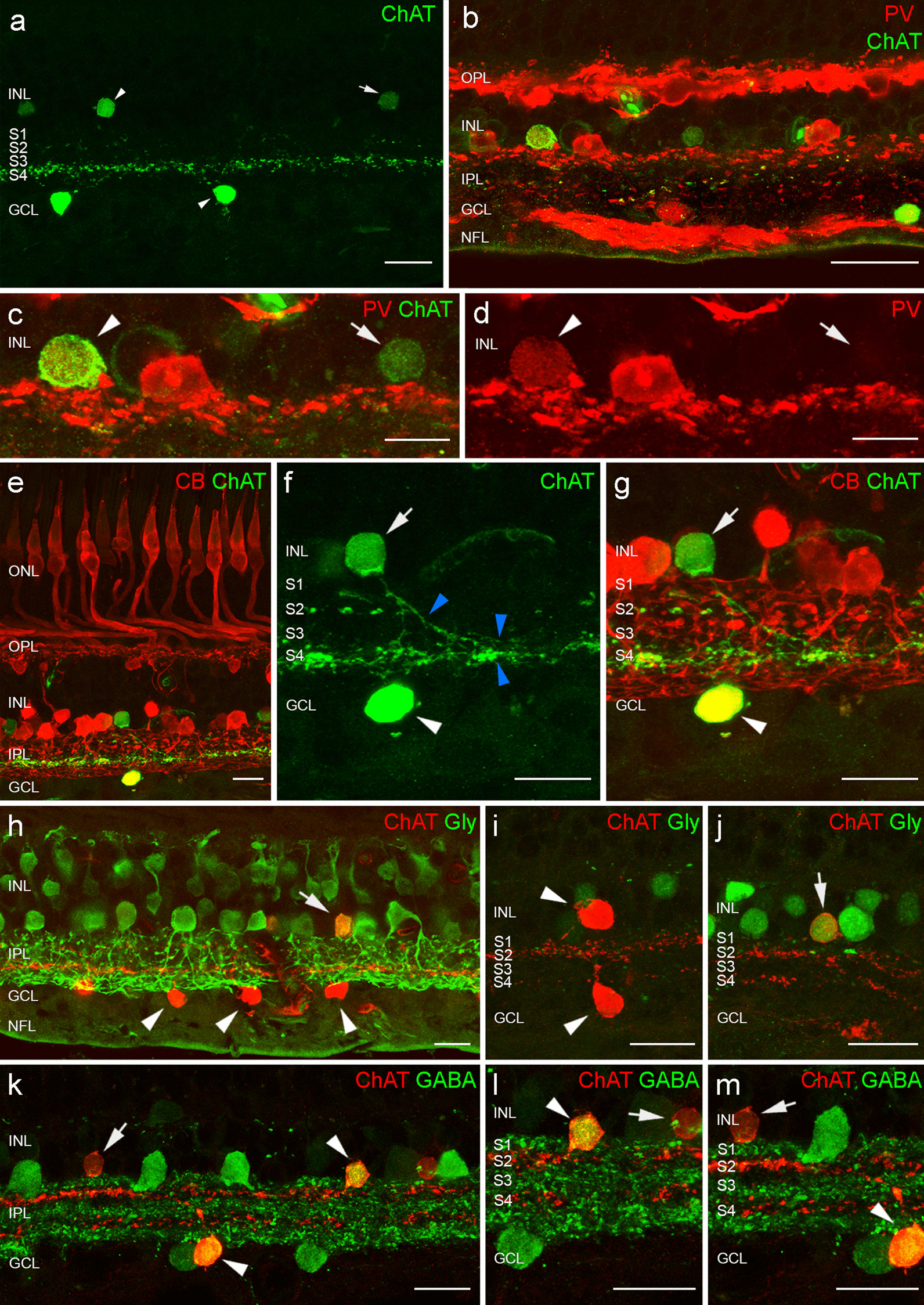 Starburst amacrine cells, involved in visual motion perception, loose their synaptic input from dopaminergic amacrine cells and degenerate in Parkinson's disease patients.