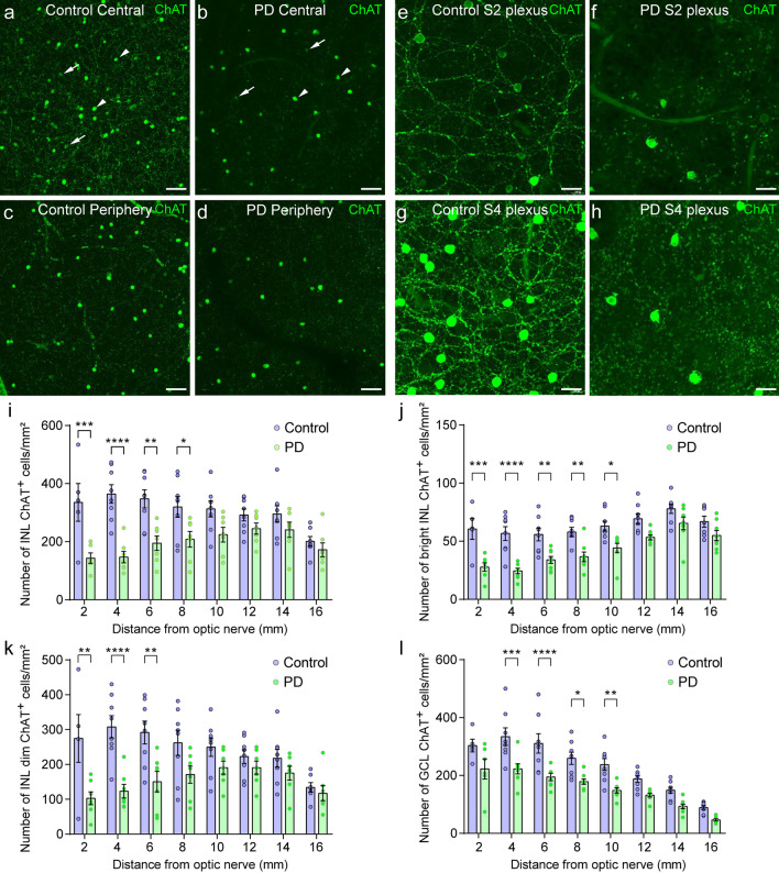 Starburst amacrine cells, involved in visual motion perception, loose their synaptic input from dopaminergic amacrine cells and degenerate in Parkinson's disease patients.