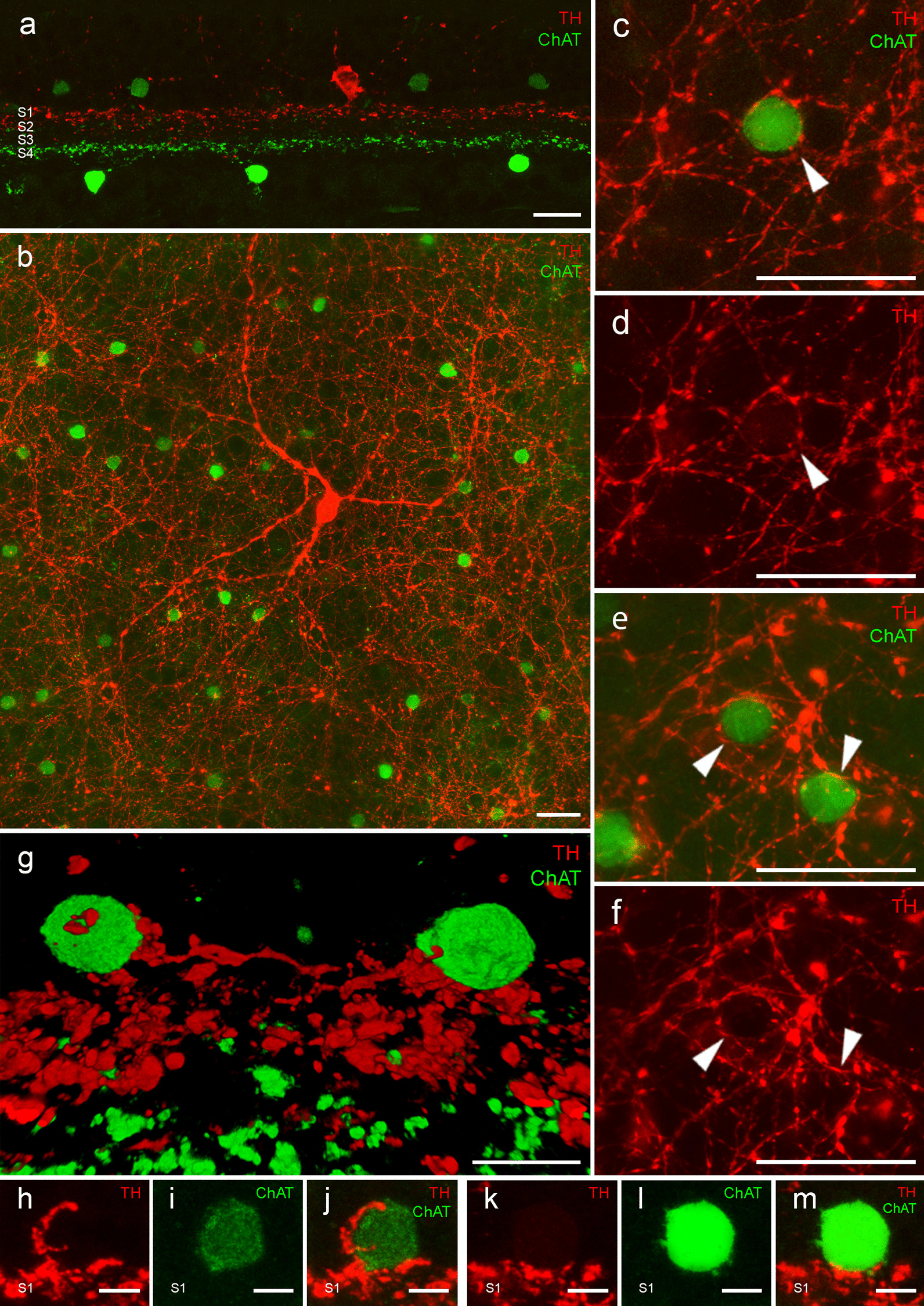 Starburst amacrine cells, involved in visual motion perception, loose their synaptic input from dopaminergic amacrine cells and degenerate in Parkinson's disease patients.