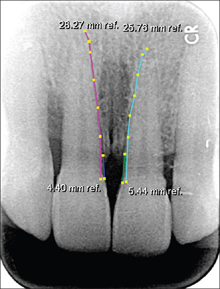 Clinical and Radiographic Evaluation of Locally Delivered Plant Stem Cells for Treatment of Periodontitis: Randomized Clinical Trial.