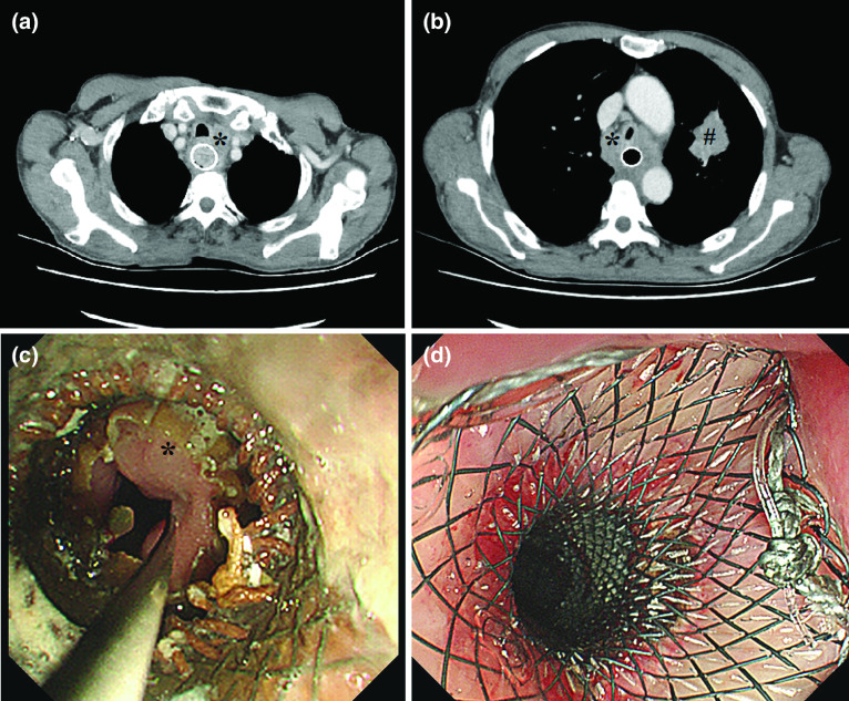 Fluoroscopic Removal of Embedded Esophageal Self-Expanding Metal Stents: Stent-in-Stent Combined with Guidewire Lasso Technique.