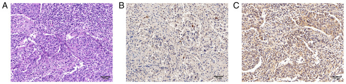 Retrospective analysis of <i>Porphyromonas gingivalis</i> in patients with nasopharyngeal carcinoma in central China.