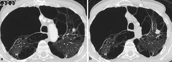 A Case Series of Non-Tuberculous Mycobacterial Pulmonary Disease Masquerading as Malignancy From a Community-Based Hospital.