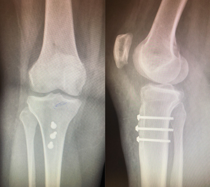 Medial patellofemoral ligament reconstruction and tibial tuberosity transfer can be used to successfully manage patellofemoral instability in the setting of trochlea dysplasia.