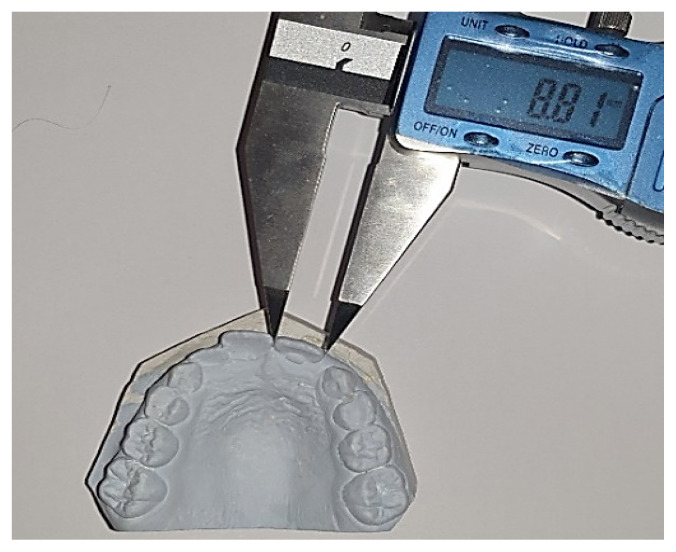 Assessing the morphological characteristics of teeth and dental arches as potential predictors of dental crowding.