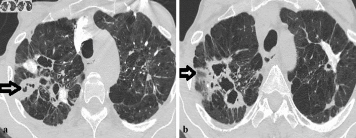 A Case Series of Non-Tuberculous Mycobacterial Pulmonary Disease Masquerading as Malignancy From a Community-Based Hospital.