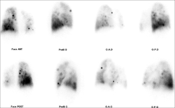 Artifactual Hot Spots on Technetium-99m Macroaggregated Albumin Perfusion Lung Scan.