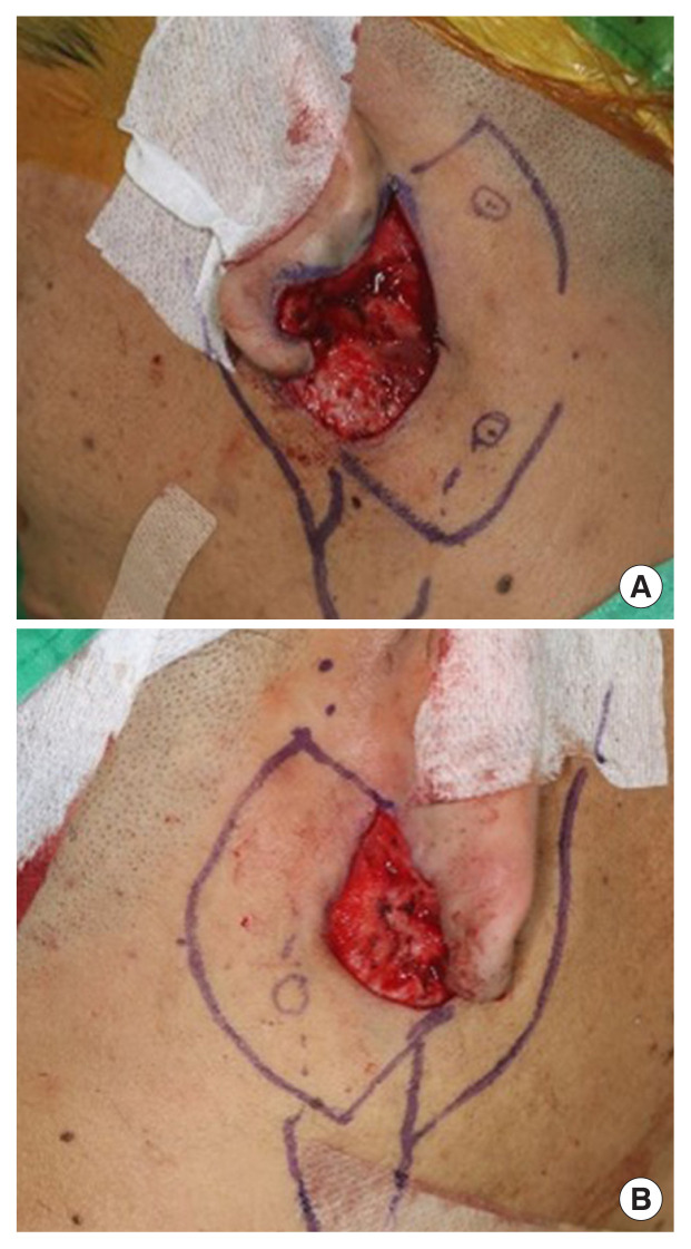 Surgical treatment of postauricular hidradenitis suppurativa with delayed diagnosis: a case report and literature review.