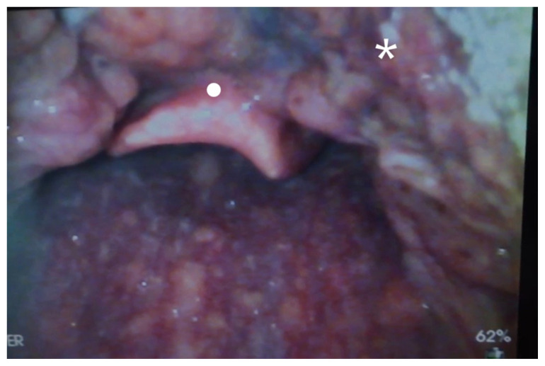 A Man with Sore Throat-A Case Report.