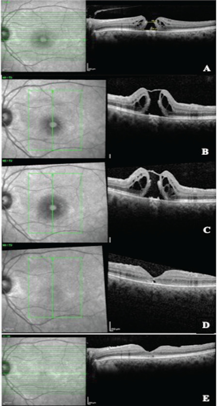 Flap-Related Complications Following Temporal Inverted Internal Limiting Membrane Flap for Macular Hole Repair.