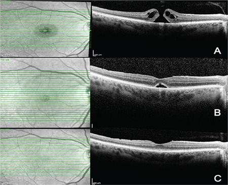 Flap-Related Complications Following Temporal Inverted Internal Limiting Membrane Flap for Macular Hole Repair.