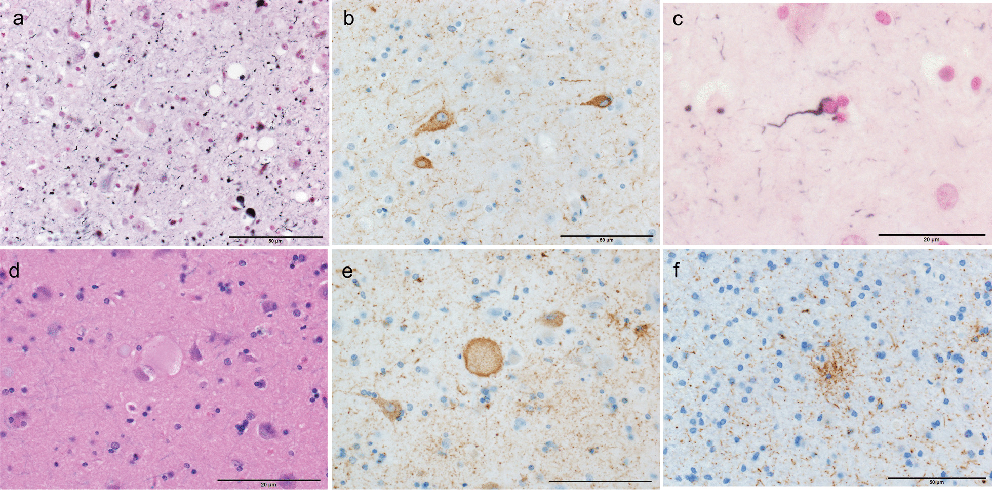 Argyrophilic grain disease is common in older adults and may be a risk factor for suicide: a study of Japanese forensic autopsy cases.