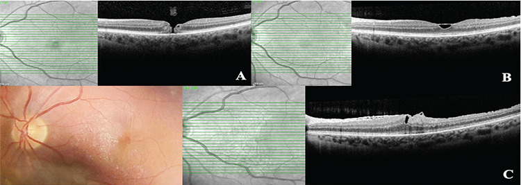 Flap-Related Complications Following Temporal Inverted Internal Limiting Membrane Flap for Macular Hole Repair.