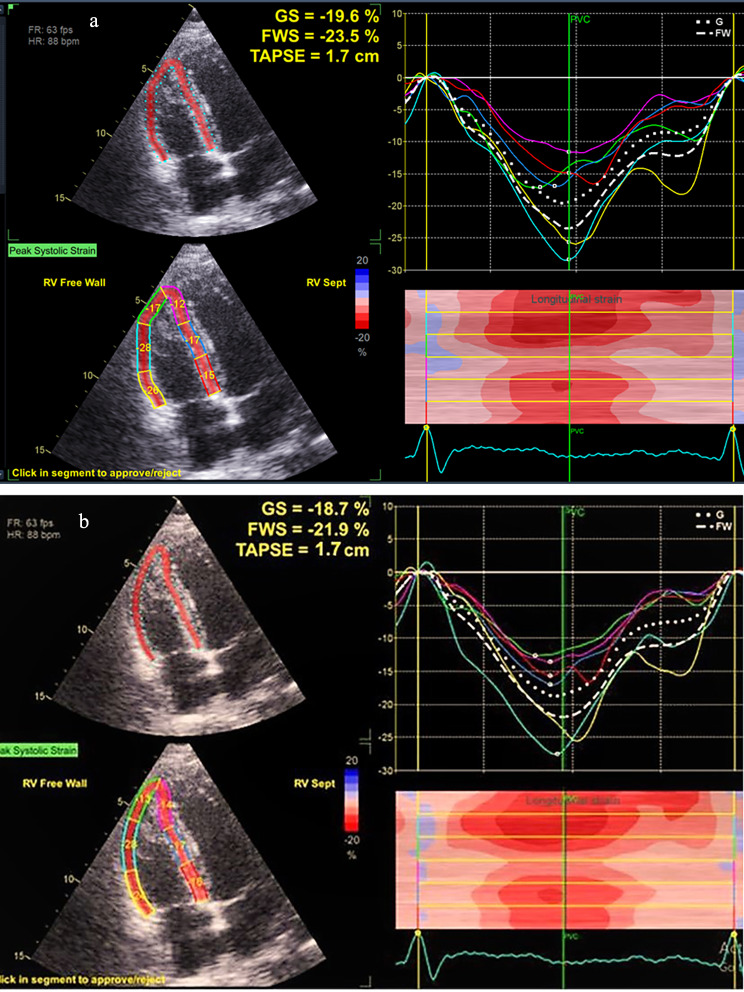 Detection of right ventricular dysfunction by three - dimensional echocardiography and two - dimensional speckle tracking in breast cancer patients receiving anthracycline- based chemotherapy.