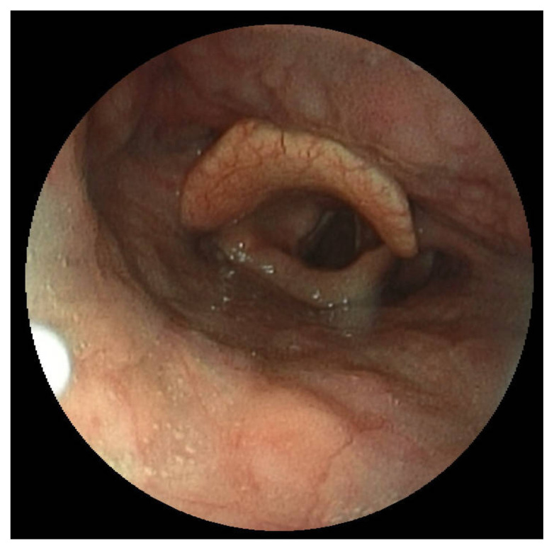 A Man with Sore Throat-A Case Report.