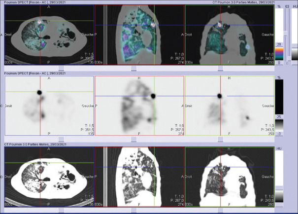 Artifactual Hot Spots on Technetium-99m Macroaggregated Albumin Perfusion Lung Scan.