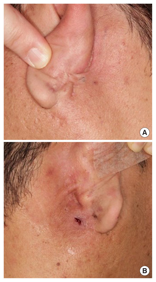 Surgical treatment of postauricular hidradenitis suppurativa with delayed diagnosis: a case report and literature review.