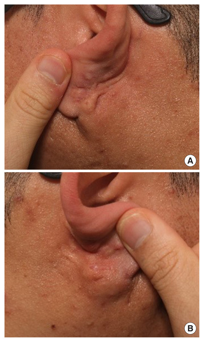 Surgical treatment of postauricular hidradenitis suppurativa with delayed diagnosis: a case report and literature review.