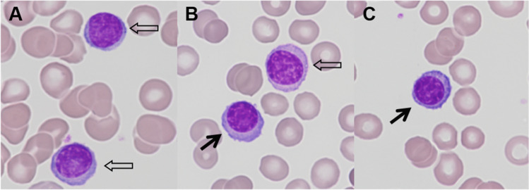 Coincidence of plasma cell leukemia and COVID-19: a diagnostic pitfall.