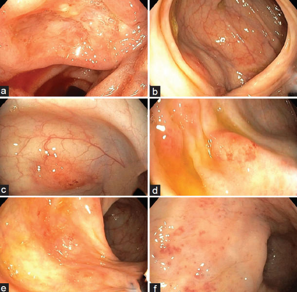 Pancolitis in Enteric Fever: A Rare Occurrence.