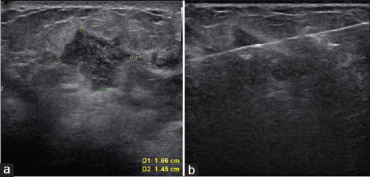 Breast Pseudoaneurysm in a Woman after Core Biopsy: Intravascular Glue Embolization.