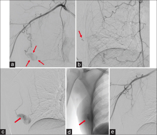 Breast Pseudoaneurysm in a Woman after Core Biopsy: Intravascular Glue Embolization.