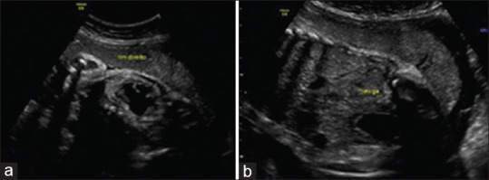 In Utero Treatment of Obstructive Ureterocele.