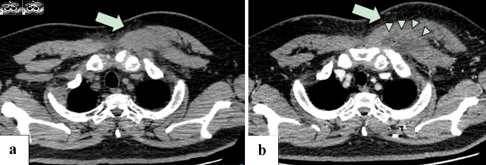 Rapidly-Progressing Pyomyositis After Chest Contusion in a Patient With Well-Controlled Diabetes Mellitus.