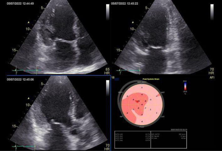 Immobilizing Interstitial Cardiac Fibrosis.