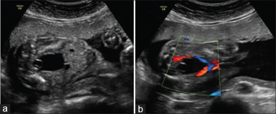 In Utero Treatment of Obstructive Ureterocele.