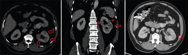 Renal BCGosis managed conservatively with antituberculous medications.