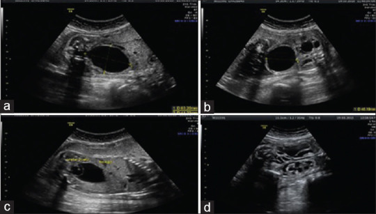 In Utero Treatment of Obstructive Ureterocele.