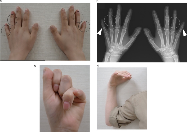 Identification of a novel nonsense NOG mutation in a patient with stapes ankylosis and symphalangism spectrum disorder.