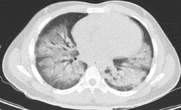 A Very Rare Combination of Hantavirus Cardiopulmonary Syndrome and Hanta Hemorrhagic Fever with Renal Syndrome.