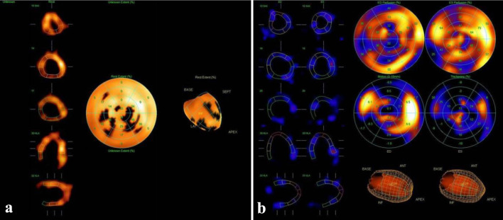 Immobilizing Interstitial Cardiac Fibrosis.