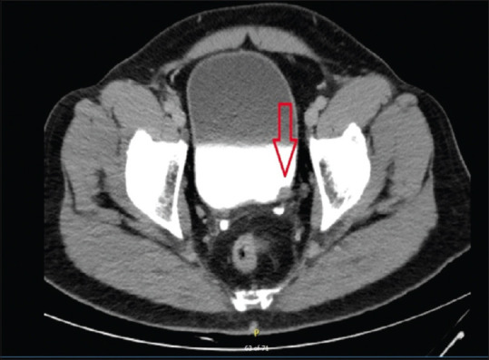 Renal BCGosis managed conservatively with antituberculous medications.