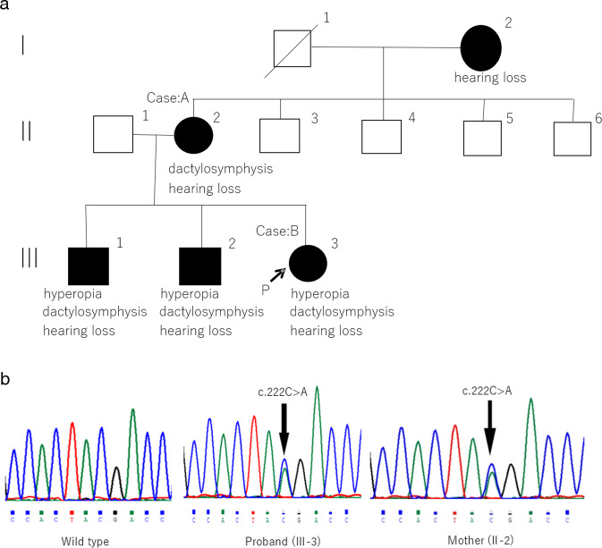 Identification of a novel nonsense NOG mutation in a patient with stapes ankylosis and symphalangism spectrum disorder.